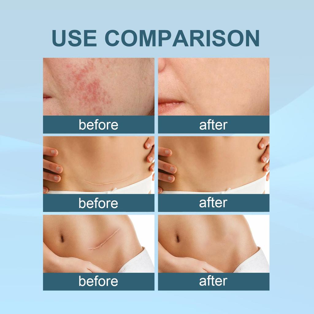 20g West&Month Gel Riparatore Cicatrici Schiarente Cicatrici Idratante Riparatore Pelle Gel Levigante Pelle