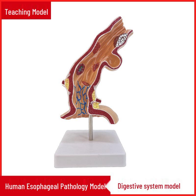 Zhenghe Esophageal Disease Pathological Model for Gastroenterology and Anatomy Teaching 28x12x7cm