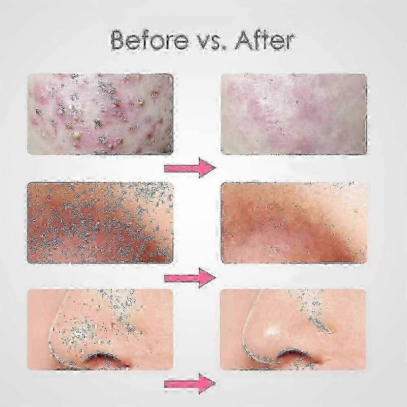 3-teilige Mitesserentfernungsklemme 8,7 cm, abgeschrägte Akneklemme aus Edelstahl, Baumwollpinzette, Schönheitsaknenadel, entfernt leicht winzige Akne, entfernt Akne blac