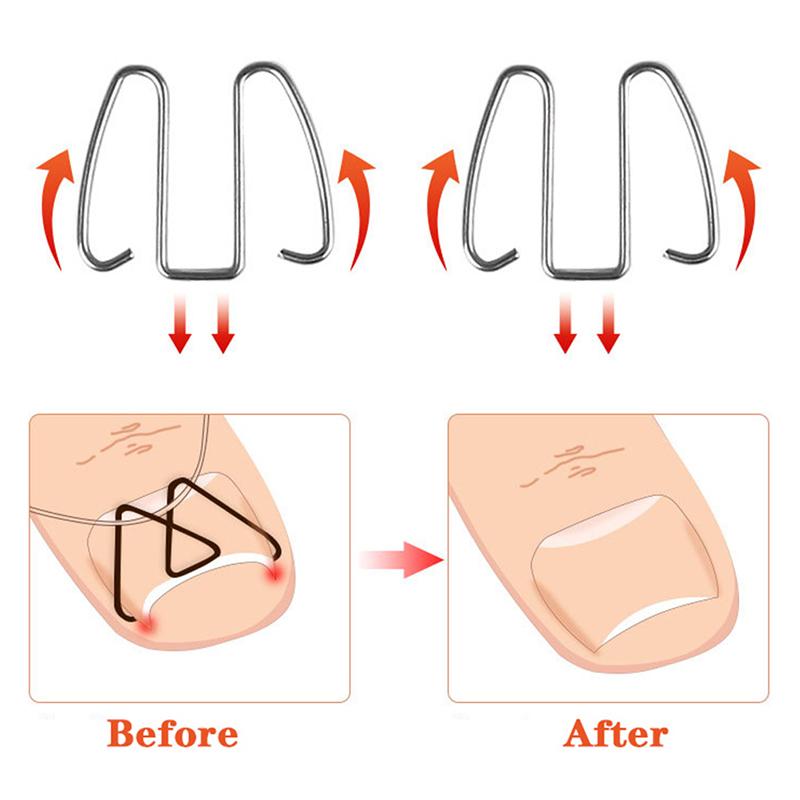 Nagelkunst Eingewachsener Zehennagel Korrekturwerkzeug Zehennagel Nagelorthese Paronychie Clip
