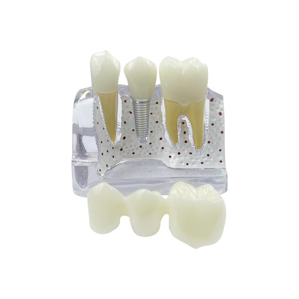 Modello Dimostrativo di Impianti Dentali 4 Volte Denti Analisi Impianti Corona Ponte Modello Rimovibile Per Studenti Dentisti Insegnamento Studio