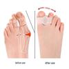 Silicone Bunion Corrector Toe Separator