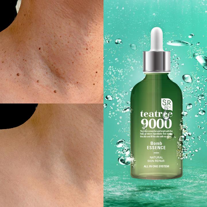 Tea Tree Bomb Milia Essence – Perfect Regeneration for Milia & Skin Blemishes