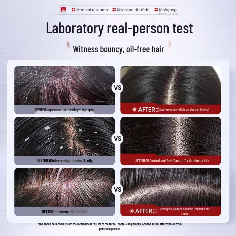 Three Hair Wizards Selenium Sulfide Oil Control Anti-Dandruff Shampoo