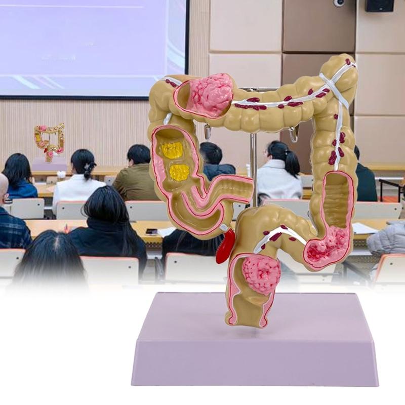 Menschliches Dickdarmmodell für Anatomie, Medizin, Lehrmodell, Pathologien des Dickdarmmodells für Studium und Ausstellung