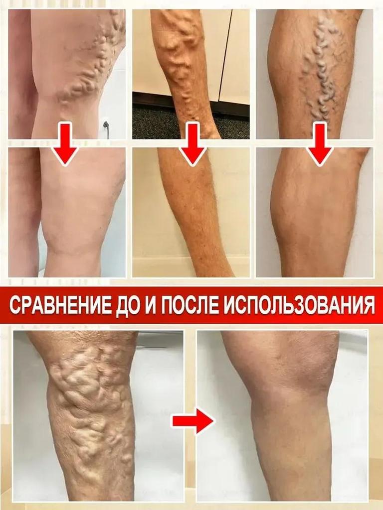 Petzoshenk German Varicose Veins Leg Veins Bulge Dilated Red Blood Cold Compress Gel