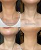 Juvederm Гиалуроновая кислота Массажный ролик для лица Бьюти-инструмент 618