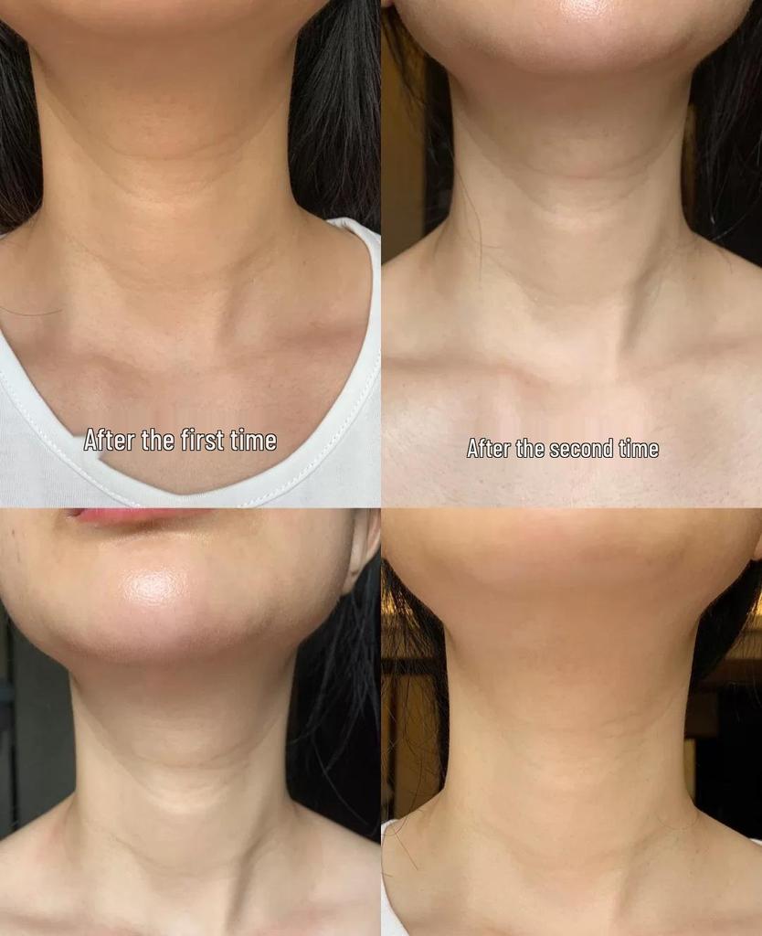 Juvederm Гиалуроновая кислота Массажный ролик для лица Бьюти-инструмент 618