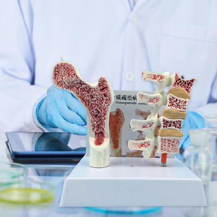 Menschliche Anatomie Osteoporose Modell Wirbel Anatomisches Skelettmodell für Medizinstudenten Lehrdemonstration