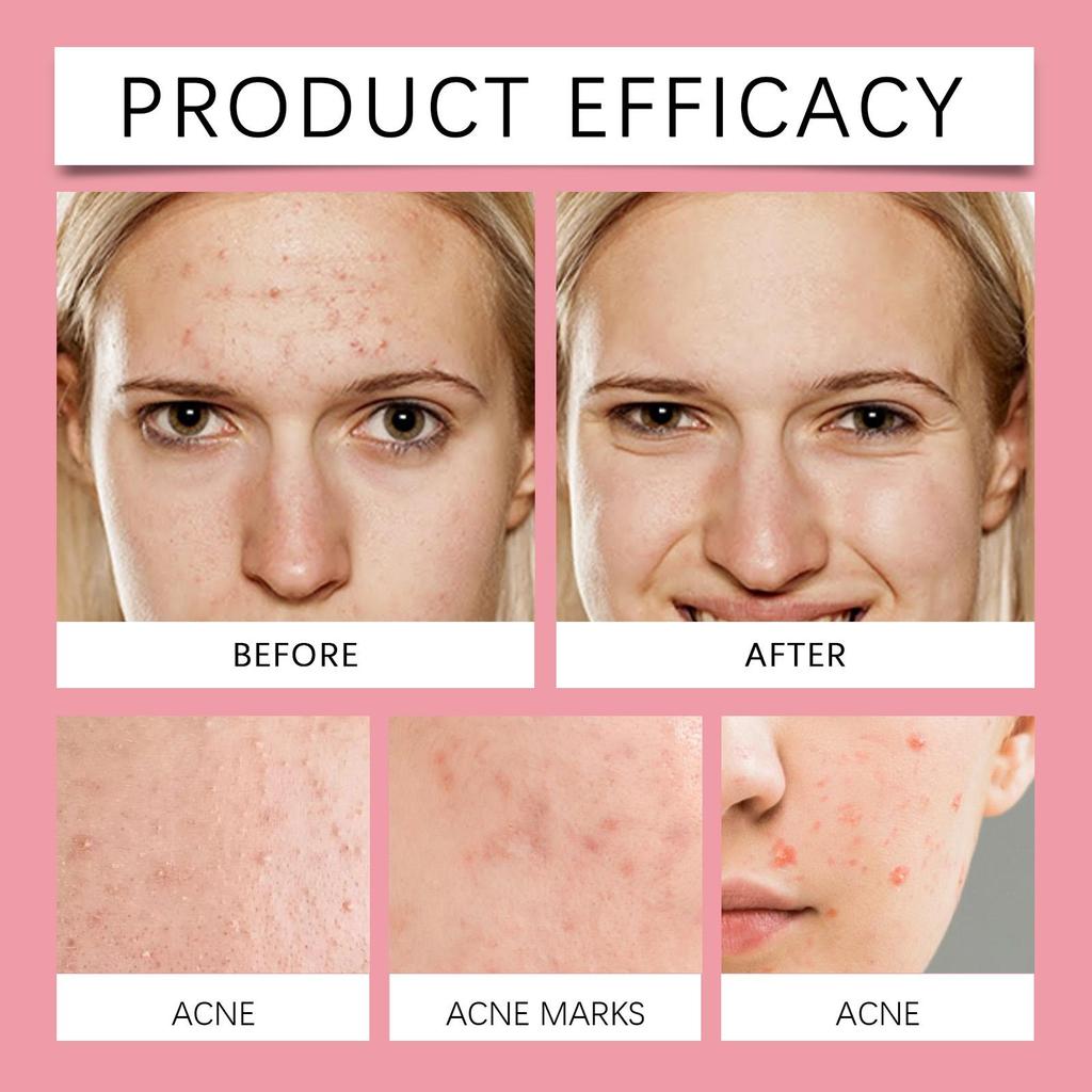 OUHOE Patchs anti-acné en forme d'étoile Hydrocolloïde Couvrance Douce Cache-cernes Autocollants Visage Quotidien pour Hommes Femmes