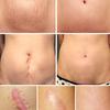 Breylee Acne Scar Removal Cream Stretch Marks Treatment Repairing Skin Care