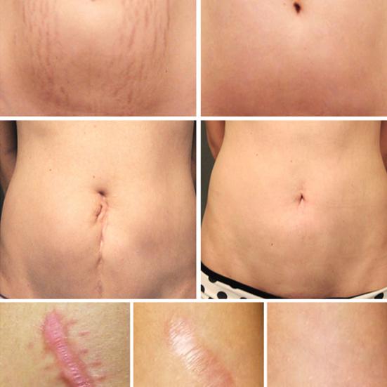 Breylee Acne Scar Removal Cream Stretch Marks Treatment Repairing Skin Care