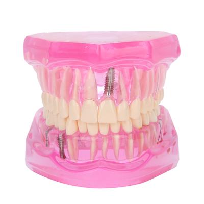 Transparent Adult Teeth Model Pathological Repair Studying Dental Teaching Tools