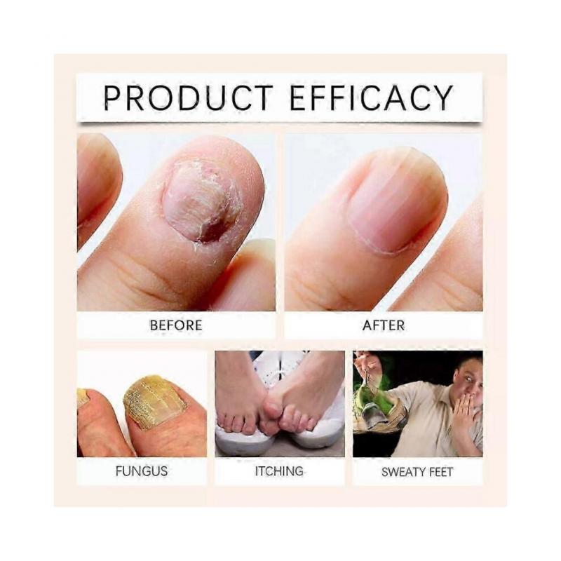 Nagelreparaturserum mit Bienengift, Nagelpflegelösung, natürliches Nagelpflegespray mit Bienengift, Spray gegen eingewachsene Zehennägel