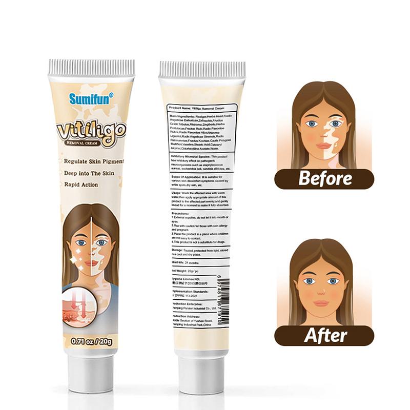 Behandlung Feuchtigkeitscreme Weißfleckenkrankheit Vitiligo Balsam Reparatursalbe
