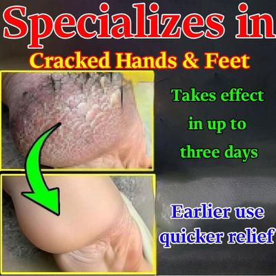 Crème pour les crevasses des pieds, engelures aux talons, sécheresse et craquelures, craquelures, craquelures, infection fongique, crevasses aux mains et aux pieds [Spécial pour les mains et les pieds secs]