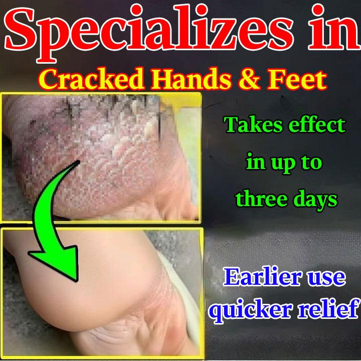 Crema per screpolature ai piedi, geloni ai talloni, secchezza e screpolature, screpolature, screpolature, infezione fungina, screpolature alle mani e