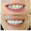 Cosmetic - Perfect Smile - Flex Fit - Silicone Teeth - Optimal Comfort - 7cm