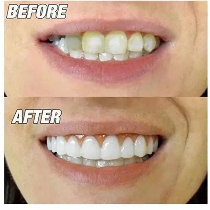 Cosmetic - Perfect Smile - Flex Fit - Silicone Teeth - Optimal Comfort - 7cm