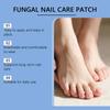 Nail Care Patches, Nail Care Correction Patches, Home Foot Patches, Comfortable And Suitable Nail Correction.
