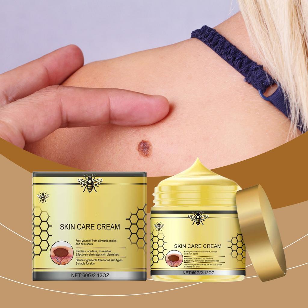 Verruca Care Cream Gentle Cleansing, Moisturizing And Softening The Skin, Reducing Skin Discomfort.