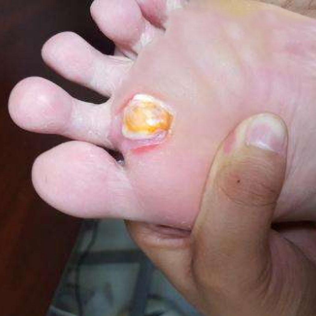 Foot Corn Remover Plaster Foot Pad Patches  Patch Pain Foot Care Tools