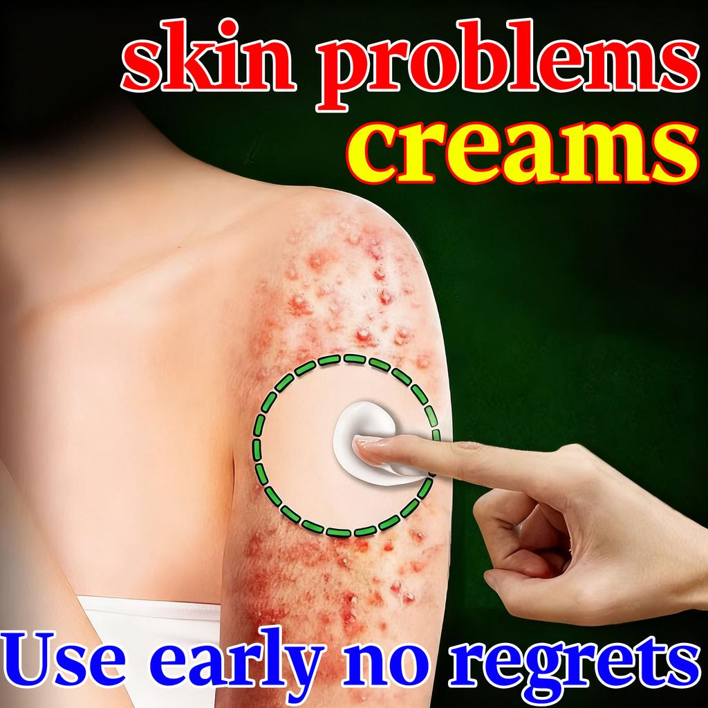 Natürliche Linderung bei juckender Haut - Kräutercreme bei Ekzemen Sanft zu empfindlicher Haut Bekämpft Dermatitis