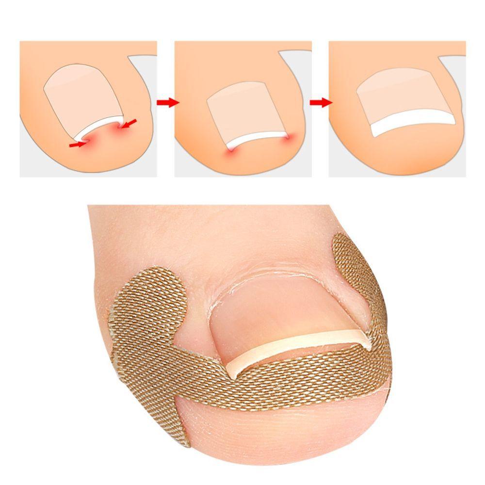 

Sticker Thumb Ingrown Toenail Tape Care Care Protection