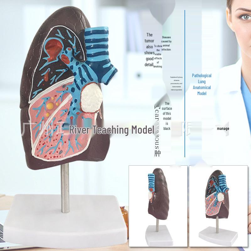 Human Pathological Lung Anatomy Model - Respiratory System 2/3 Scale