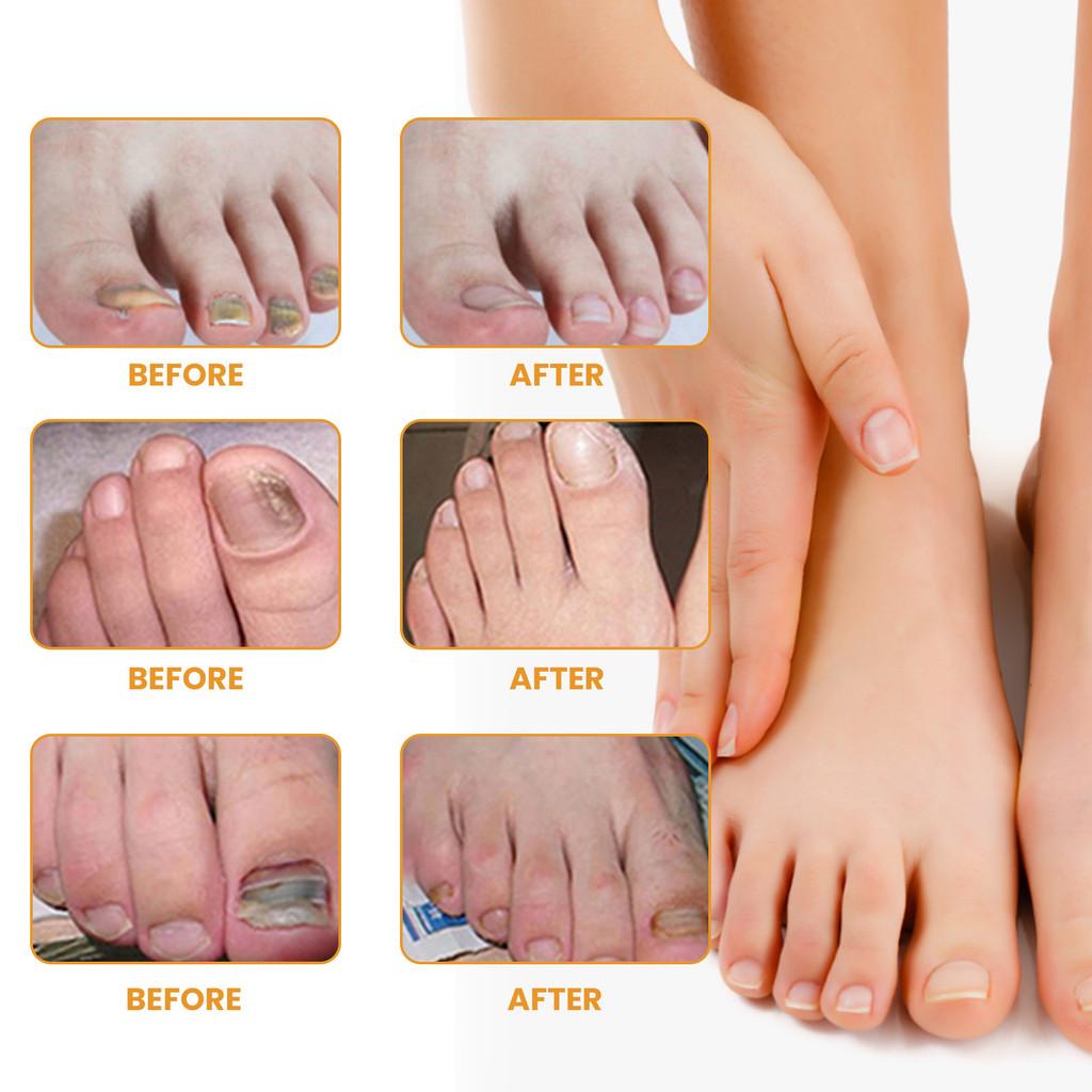 Ximonth Nail Repair Patch 32pcs Softening Thickening Treatment For Damaged Nails