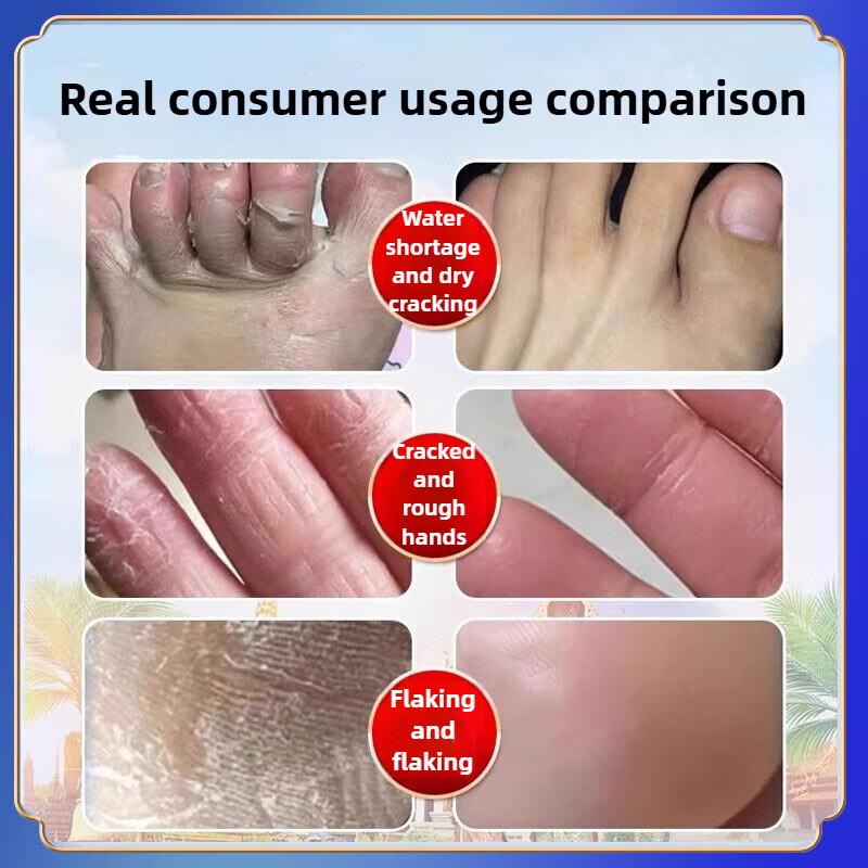 Cracked Hands and Feet Soothing Repair Cream, Focusing on Cracked Feet, Itching and Molting Improvement