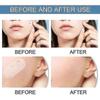 320pcs Large Acne Patch Pimple Hydrocolloid Stickers Spot Cover Remover Treatment
