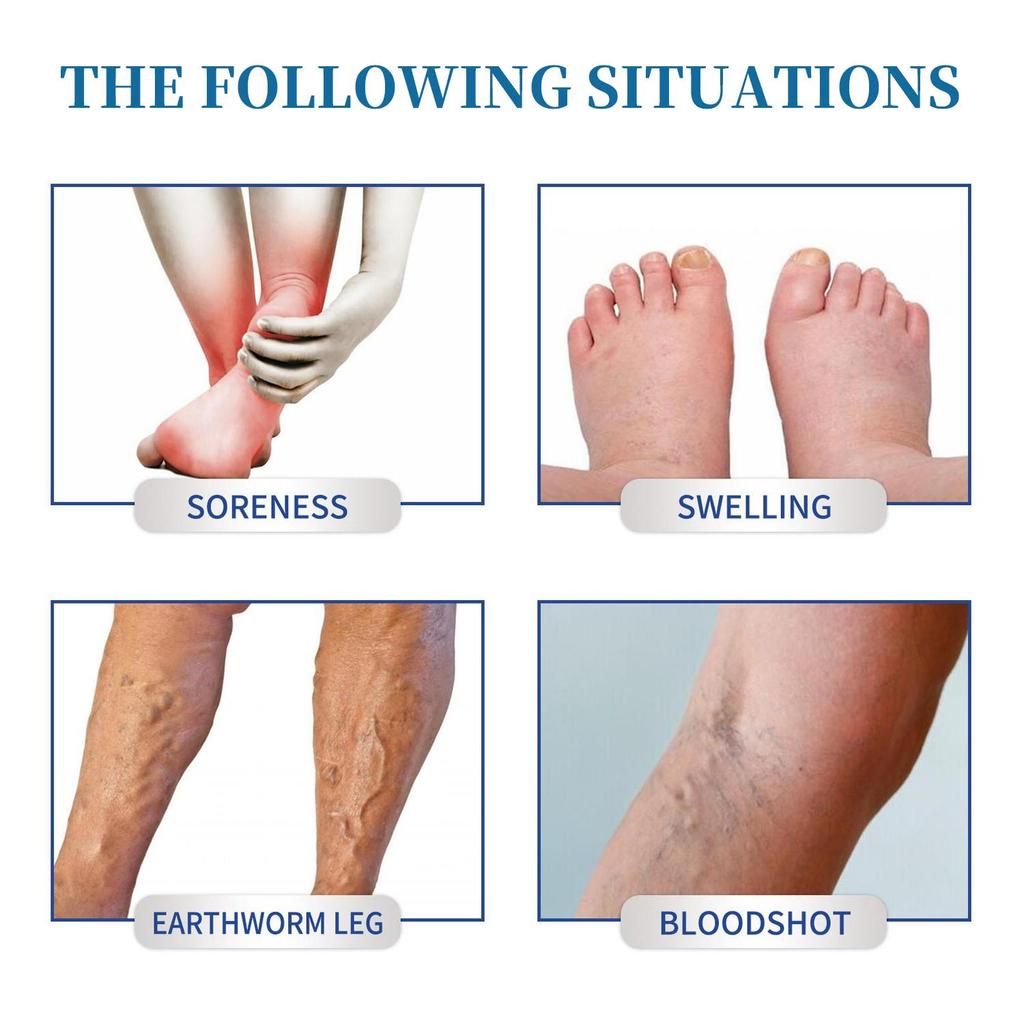 Varicose Veins Cream-Improve Blood Circulation-Relief Swelling And Pain-Minimize Varicose Vein & Spider Vein, 50g