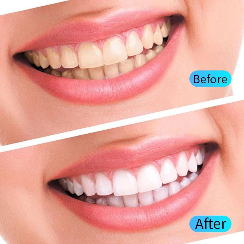 Kit de Gel Blanqueador de Dientes de 10/20 Piezas Cuidado de Higiene Bucal Herramienta Blanqueadora de Dientes Herramienta Blanqueadora de Dientes con Luz Filtrada Eliminar Manchas de Placa