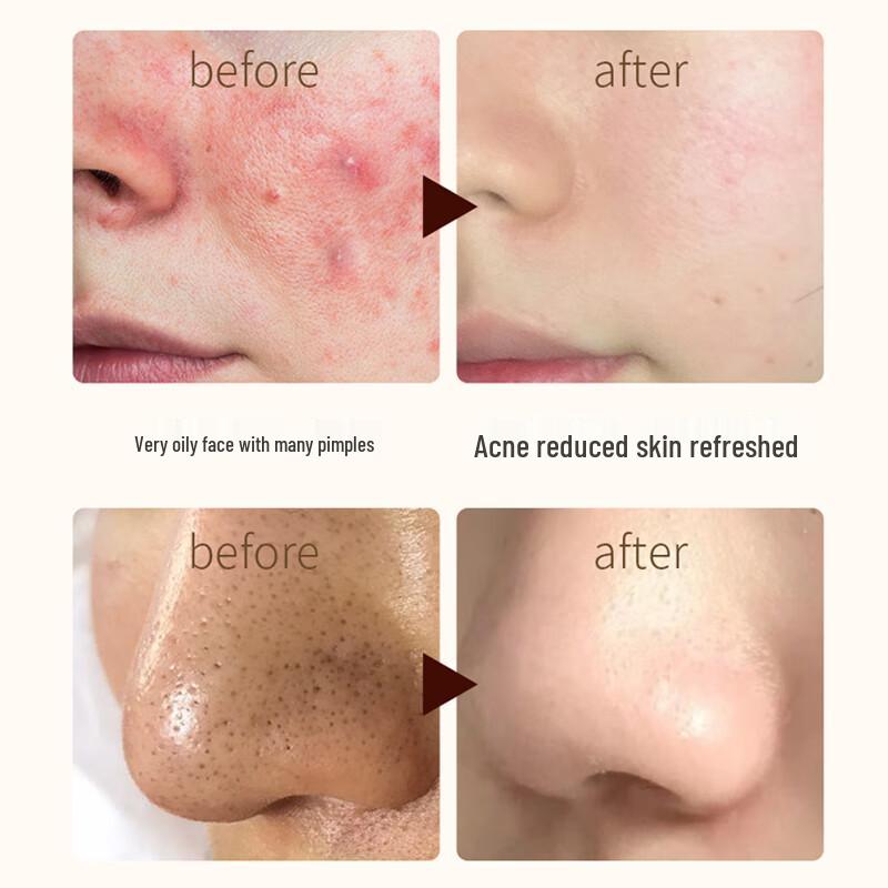 FIVERAMS Sulfur Acne & Oil Control Facial Cleanser