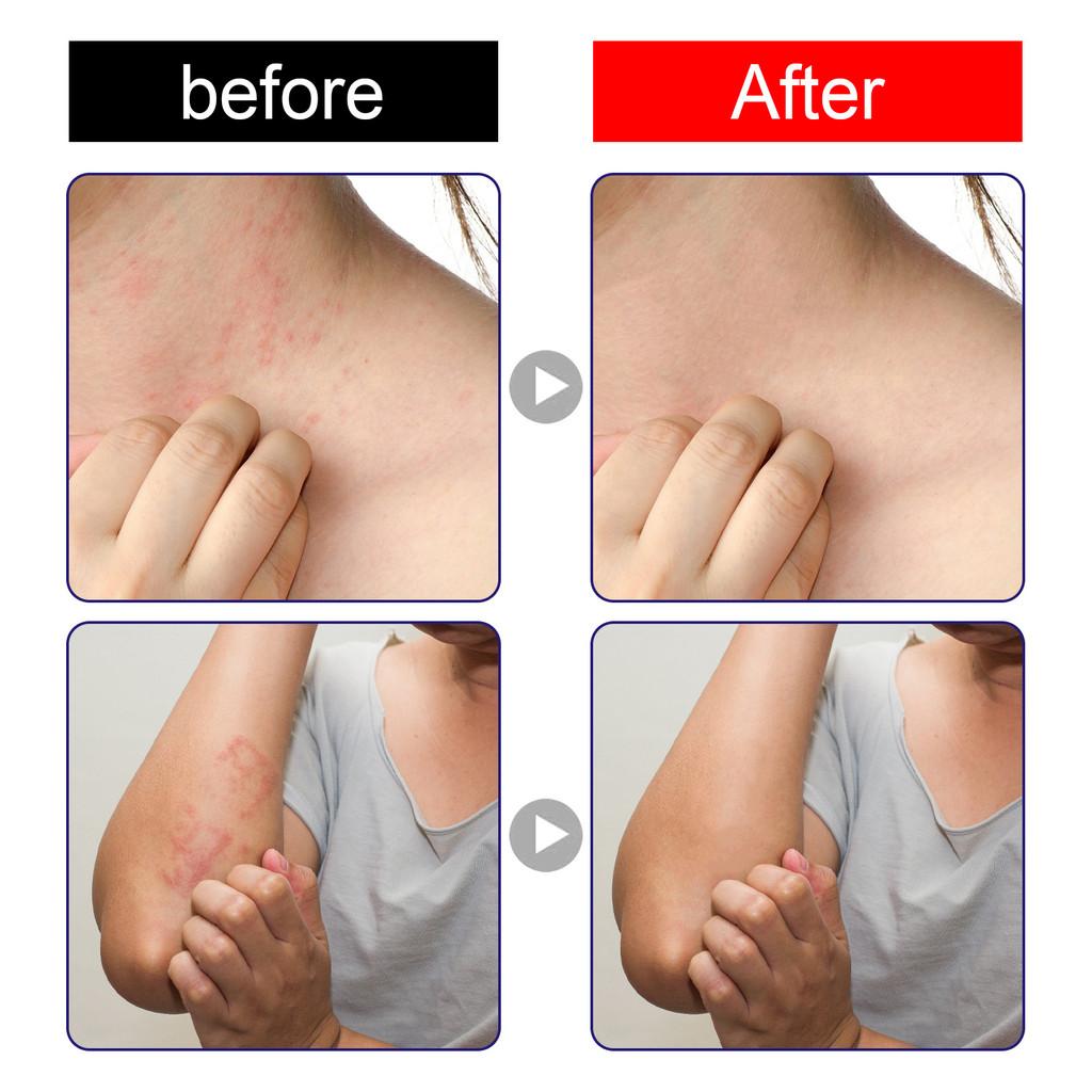 South Moon Purple Flower Skin Care Cream For Mosquito Bites And Redness Relief 30g Box