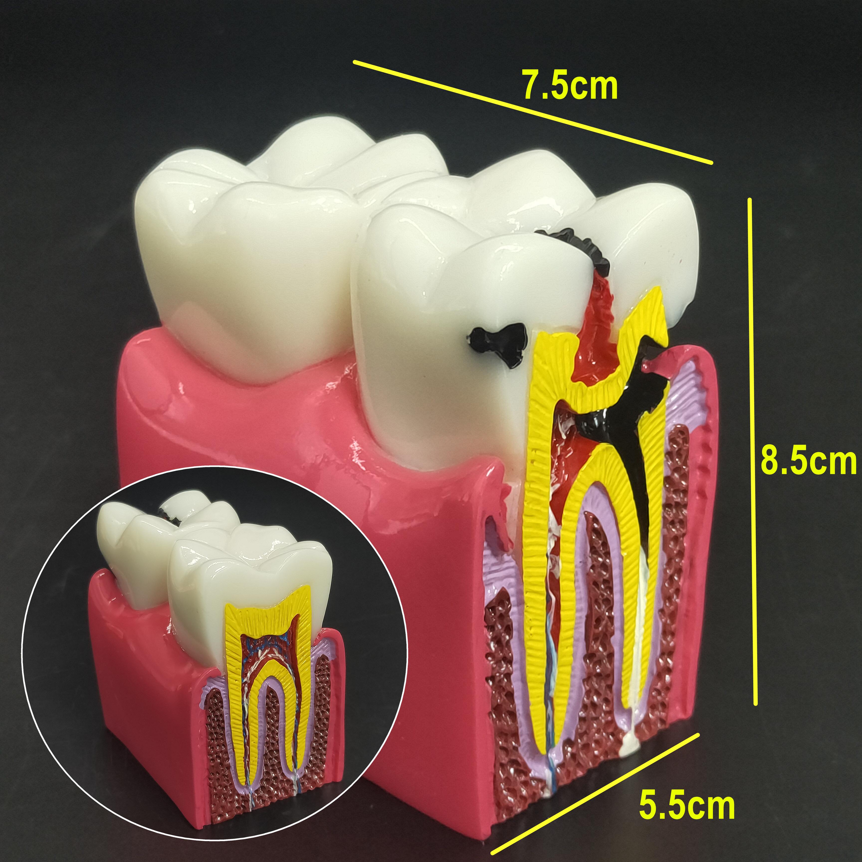

1 шт., модель зубов для обучения анатомии зубов, 6 раз, модели для сравнения кариеса для обучения и исследований стоматолога 1 piece A
