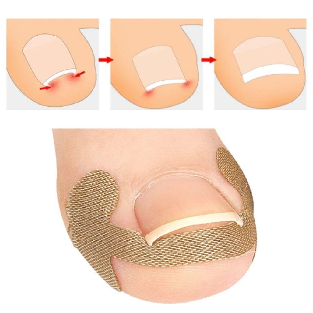 

Ingrown toenail protection sticker toenail care toenail care pedicure band