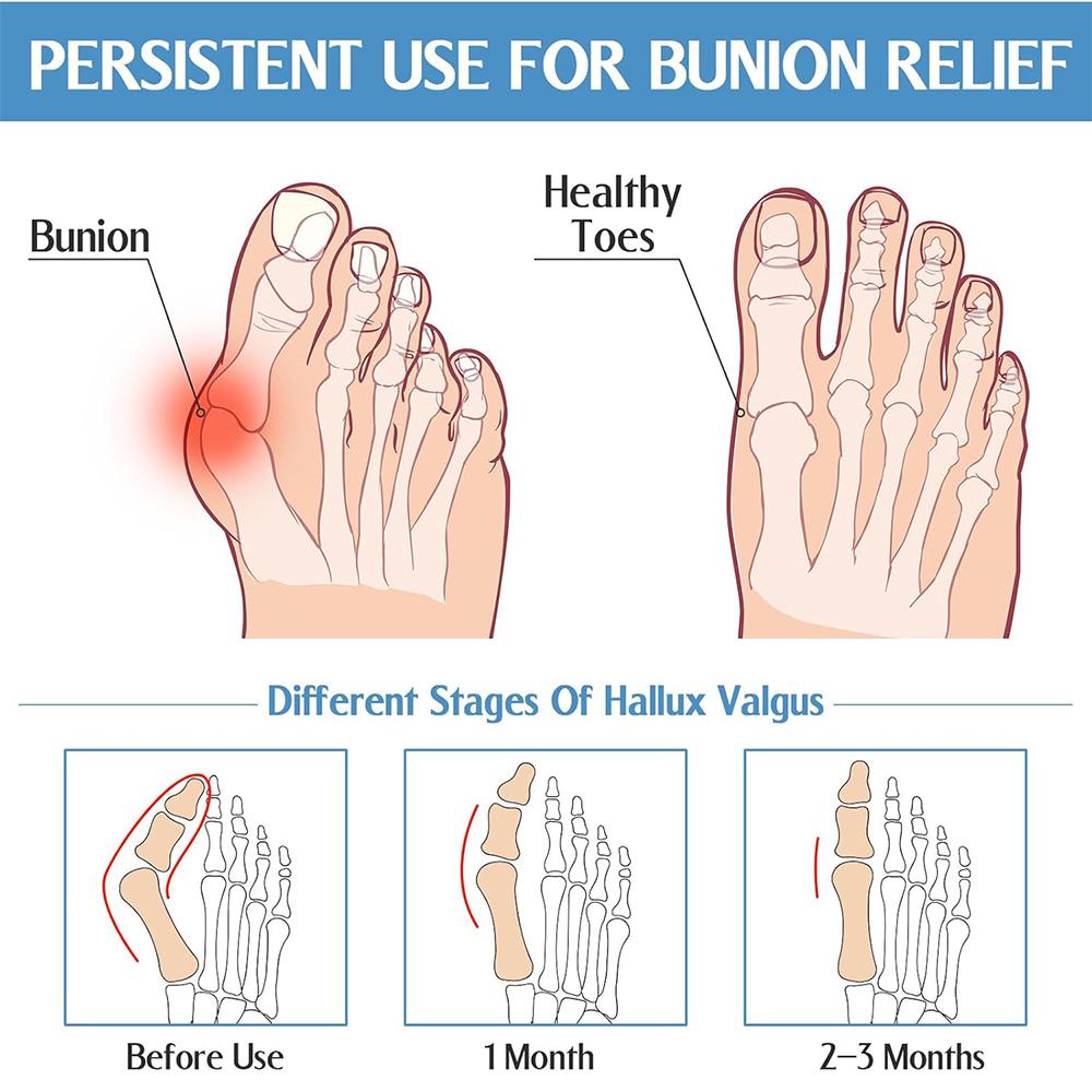Bunion Corrector Halux Valgus Corrector Bunions Corrector For Women Toe Separator Foot Finger Separators Hallux Valgus Corrector