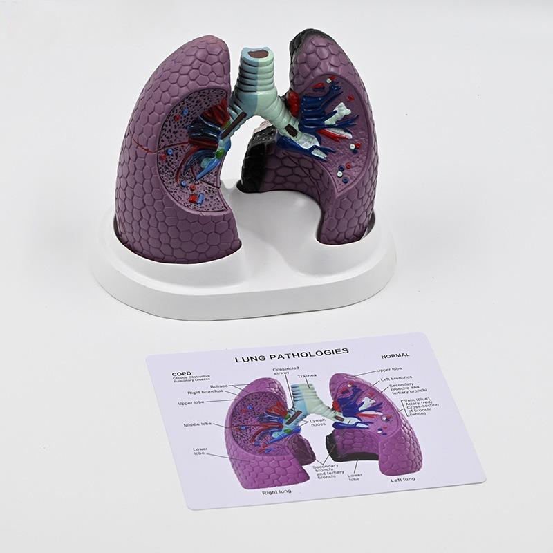 Human Lung Model Smoking Disease Respiratory Specimen Healthy Lung Thoracic Surgery Lung Anatomical Model