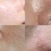 Acleon Anasis Blackhead Remover Seborrheic Scalp Scaling 1000ml + Pore Ampoule 15ml