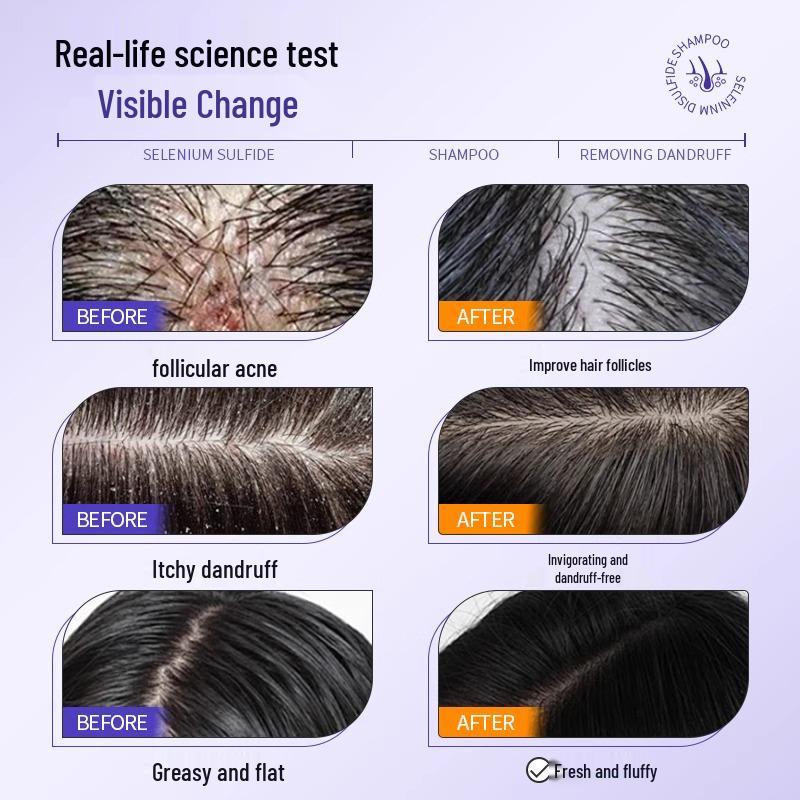 Selenium Sulfide Anti-Dandruff Shampoo: Oil Control, Anti-Itch, Deep Cleansing, Long-Lasting Fragrance for Men and Women.