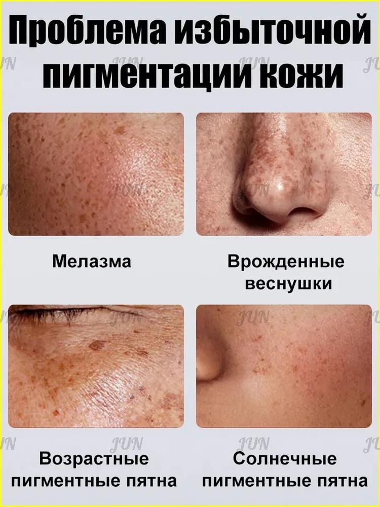 Retiderm anti-aging face cream, Freckle removal and whitening cream is able to remove freckles, chloasma, sunspots, age spots, Contains hyaluroni