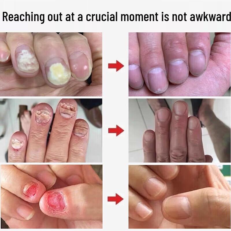 DR.JOINTNA Fungal Nail Treatment