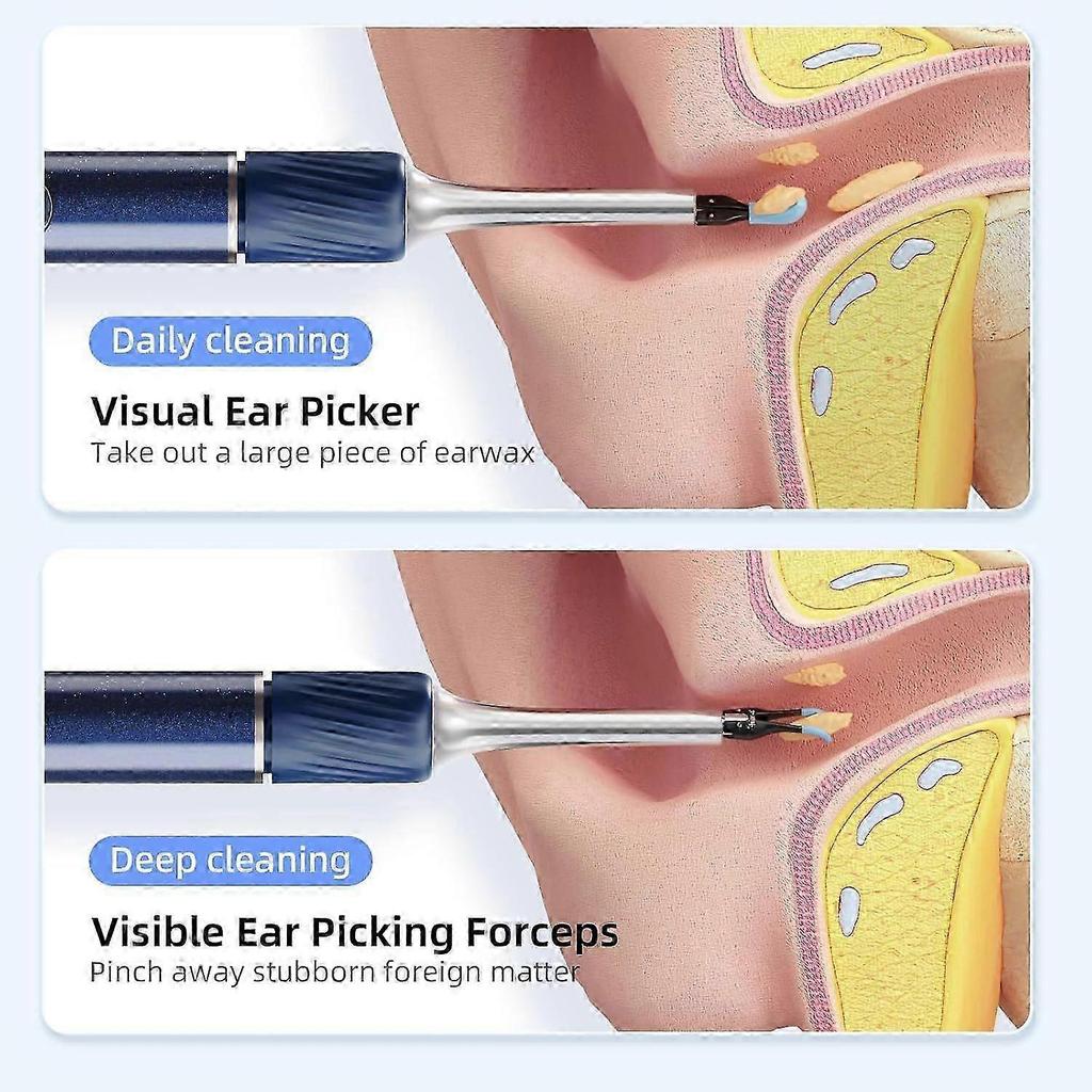2025 Ohrenkamera mit Pinzette und 1080P HD für sichere und klare Ohrenreinigung im Vereinigten Königreich