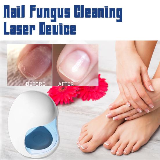 Nail Fungus Cleansing Lasers Relief Device Easy To Operate Blue Light Therapy Infrared Cold Lasers Nail Care Device