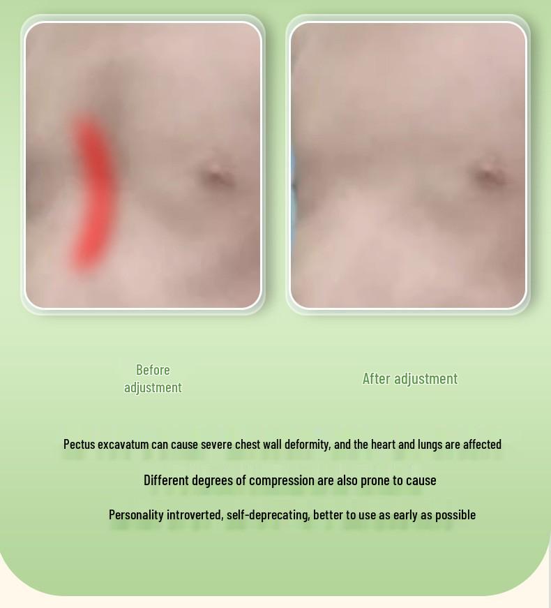 Korektor pectus excavatum střední hmotnosti s podtlakem pro korekci vkleslé hrudi a zlomeniny hrudní kosti