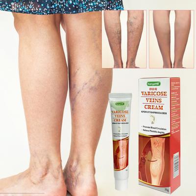 Varicose Veins Paste, Remove Varicose Veins, Varicose Veins Curing For Legs, Veins Removal For Legs, Varicose Vein Renovate Paste