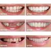 2 Paia, Naturale e Confortevole Ritrova Fiducia Sorriso, Regolabile Temporaneamente per Uomini e Donne(bianca)