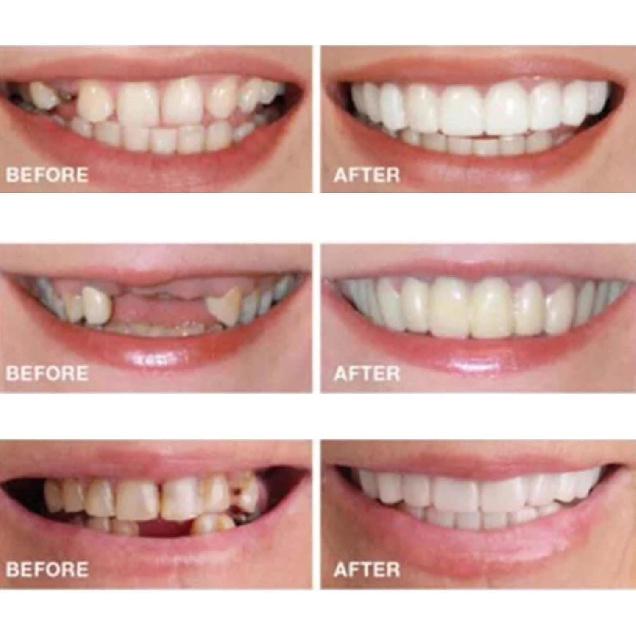 2 Paia, Naturale e Confortevole Ritrova Fiducia Sorriso, Regolabile Temporaneamente per Uomini e Donne(bianca)